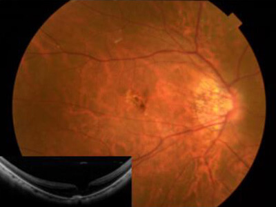 近視性脈絡膜血管新生